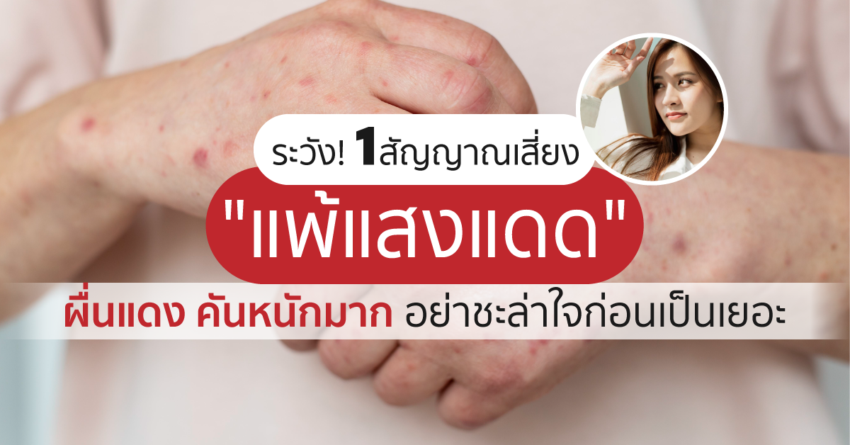 Images/Blog/aJWlXC1m-ระวัง! 1สัญญาณเสี่ยง แพ้แสงแดด ผื่นแดง คันหนักมาก อย่าชะล่าใจก่อนเป็นเยอะ.png